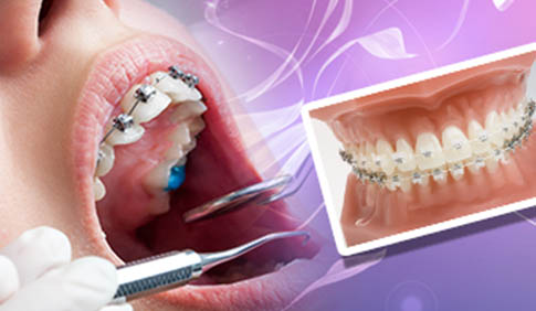 Emergency Care Goldreich Orthodontics Plano Tx